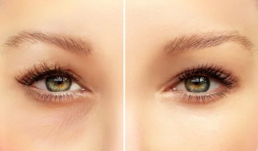 Infos chirurgie des paupières